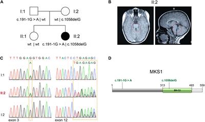 Novel Compound Heterozygous Variants in MKS1 Leading to Joubert Syndrome